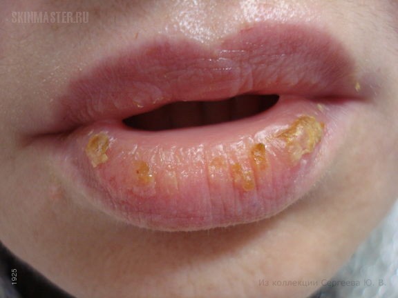 Почему губы трескаются и шелушатся, и что с этим делать? Советы экспертов