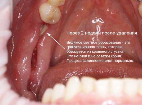 Сколько болит и как заживает десна после удаления зуба?