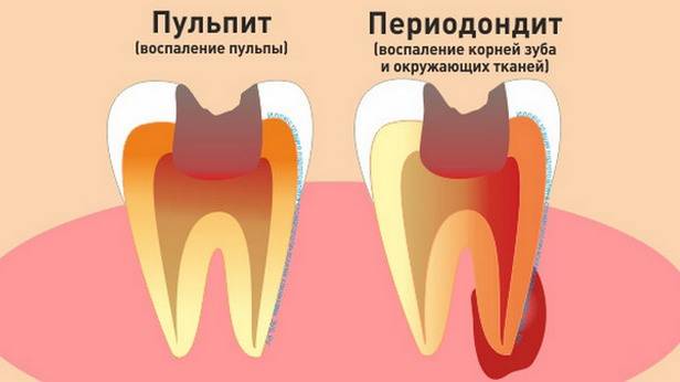 Периодонтит