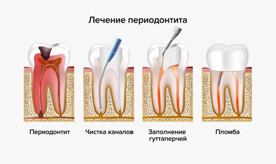 Лечение периодонита